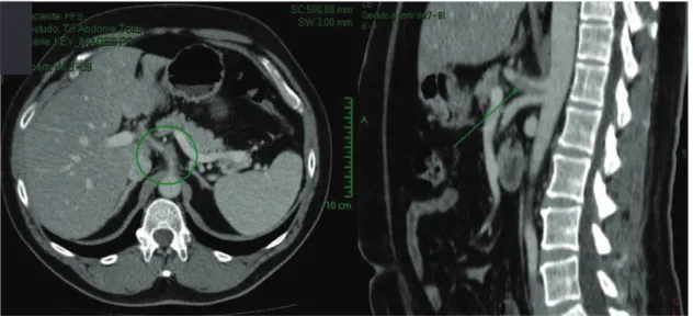 Figura 4. TC de Abdome: corte axial e sagital evidenciando lâmina de dissecção no tronco celíaco com perviedade da artéria 