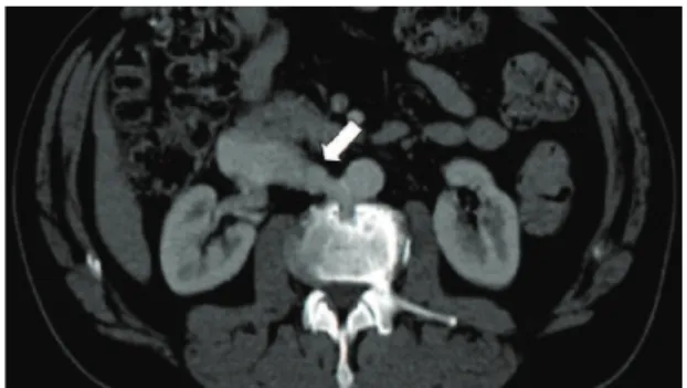 Figura 1. Angiotomografia de aorta abdominal evidenciando 