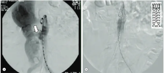 Figura 4. a) Angiografia evidenciando cateter pigtail centimetrado na aorta com visualização da comunicação entre aorta e veia 