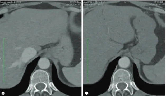 Figura 6. Tomografia Computadorizada de abdômen comparando os achados de antes do tratamento (à esquerda) com os de 