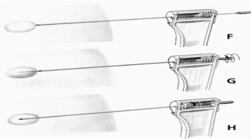 Fig. 4- Desenho ilustrativo do Rotex screw needle biopsy instrument.  Fonte: site   http://www.ursus.se/ursus/order.shtml) 