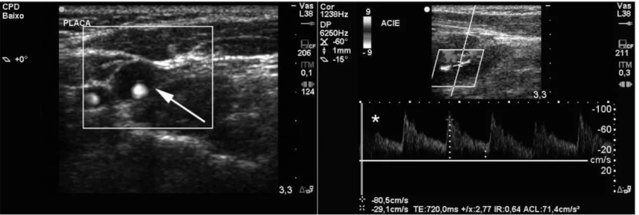 Figura 2. Ultrassonograia com doppler de carótida, mostrando ACI esquerda com material hipoecoide em seu lúmen (seta) e 