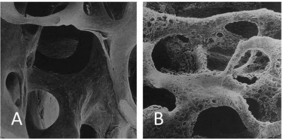 Figura 1  - (A) Substância esponjosa normal. (B) substância esponjosa na osteoporose 