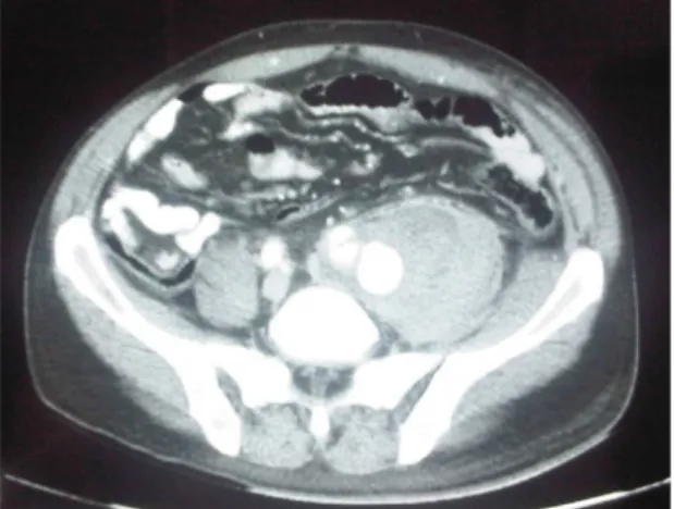 Figura 4. Tomografia mostrando coleção retroperitoneal em 