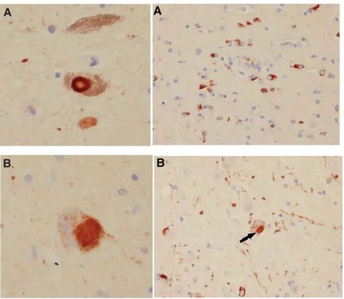 Figure  1.  Microscopic  findings  in  PD  (on  the  left)  and  MSA  (on  the  right)  with  aSyn  immunohistochemistry