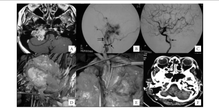 Figura 4. A) Ressonância nuclear magnética axial em T1 com gadolíneo evidenciando lesão na topograia do forame jugular direito compatível com para-