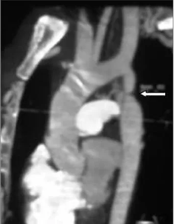 Figura  2.  Angiotomografia  do  paciente:  imagem  de  estreitamento 