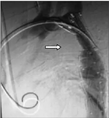 Figura 4. Tratamento endovascular de coarctação da aorta: implante 