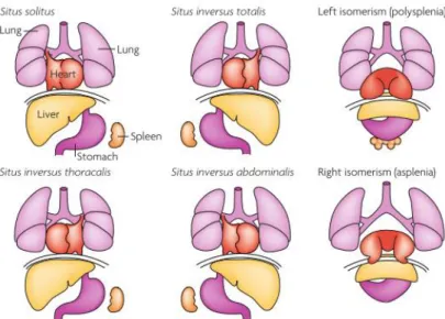 Figure  1  –  Human  Laterality  disorders  -  Schematic  illustration  of  normal  left–right  body  asymmetry  (situs  solitus) and five laterality defects that affect the lungs, heart, liver, stomach and spleen