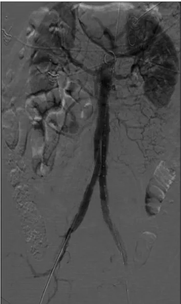 Figura  3.  Arteriografia  intraoperatória  evidenciando  perviedade  da 