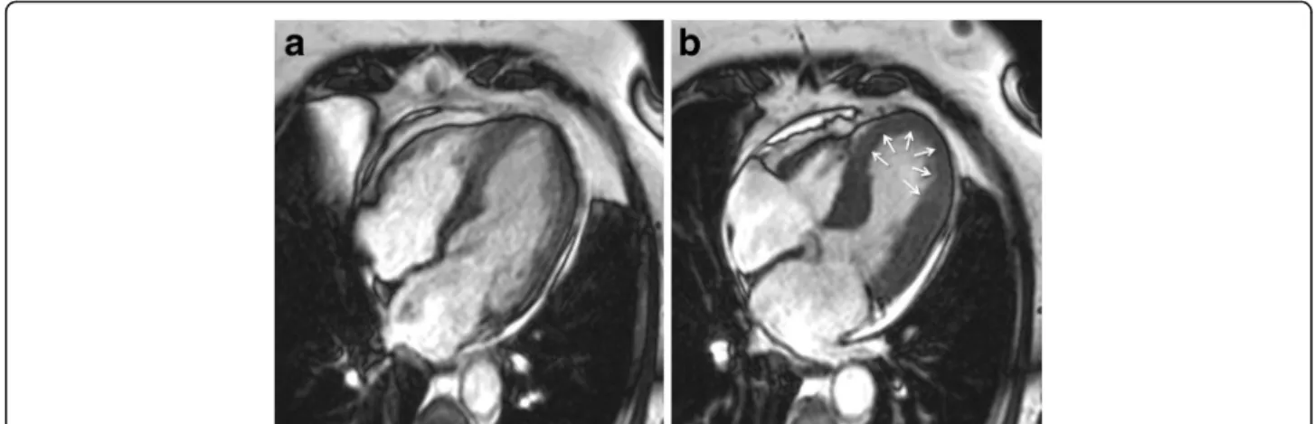 Fig. 2 Typical apical balloning in takotsubo syndrome. Cine CMR 4-chamber view (a-late diastole; b-late systole)
