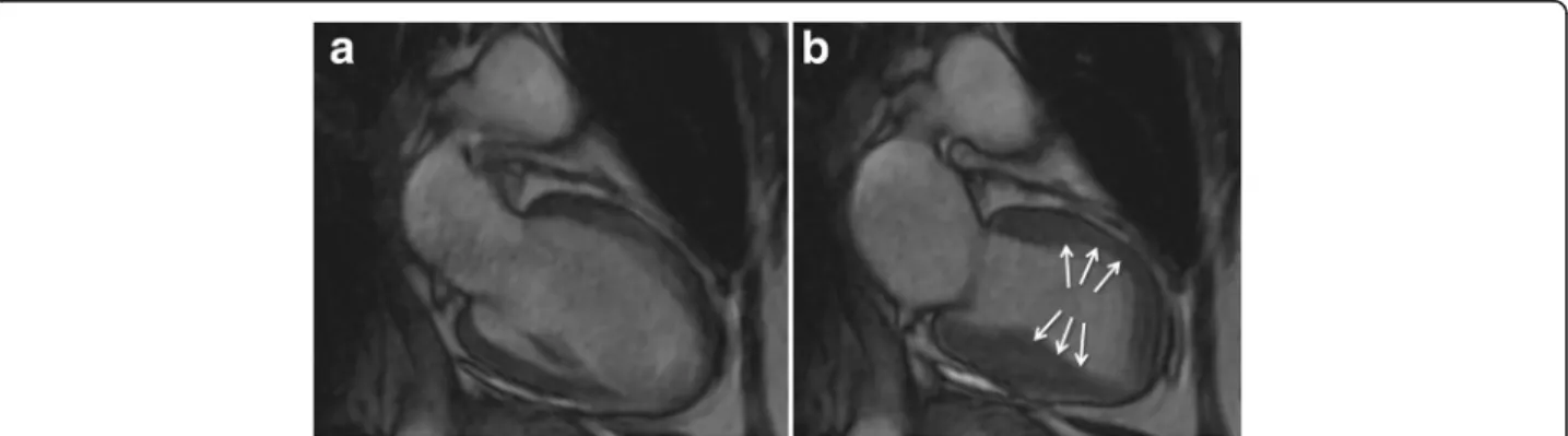 Fig. 5 Mid-ventricular variant of takotsubo syndrome. Cine CMR 2-chamber view (a-late diastole; b-late systole)