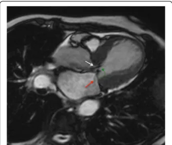 Fig. 6 Cine CMR in horizontal long-axis view demonstrating the systolic “ jet ” in left ventricular outflow tract (white arrow) with associated systolic anterior motion of the mitral leaflets (green arrow) and functional mitral valve regurgitation (red arr