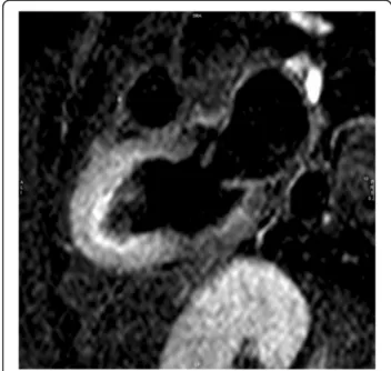 Fig. 9 Myocardial edema. T2-weighted triple-inversion recovery 2- 2-chamber view showing transmural signal hyperintensity in the mid-apical segments of left ventricle