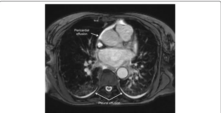 Fig. 12 Pericardial and pleural effusions in a patient with takotsubo syndrome. Cine CMR axial view at the level of the pulmonary valve