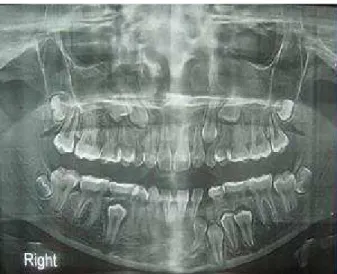 Figura 7- Ortopantomografia: mulher, 20 anos, com dentes permanentes 13,14,23,24,32,33,34,35,45 não  erupcionados (Gupta, R., et al., 2014)
