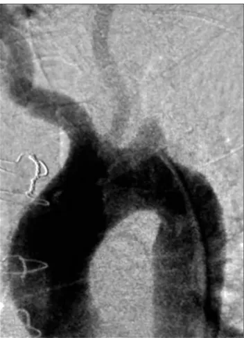 Figura  4.  Angiograia  de  controle  pós-angioplastia  com  implante  de 