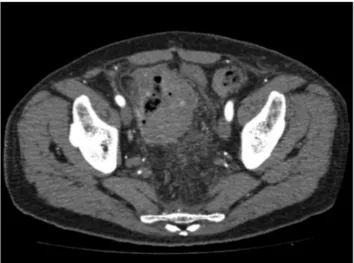 Figura 2. Angiografia final demonstrando implante de uma endo-