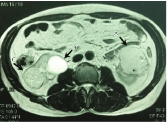 Figura 2. Arteriograia renal esquerda pré-embolização; fase tardia. As 