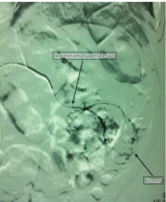 Figura 4. Arteriograia renal esquerda pós-embolização. Observa-se 