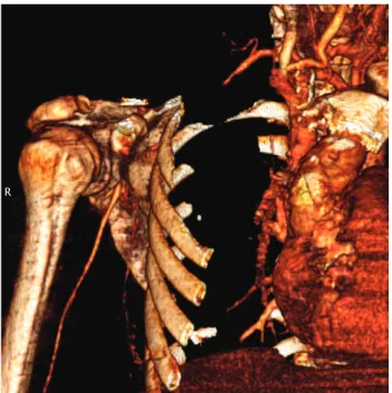 Figura 2. Angiotomografia com reconstrução tridimensional evidenci-