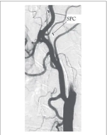 Figura 2 – Espasmo artéria carótida interna. Notar a presença do siste-
