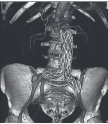Figura  1  -  Tomografia  de  abdomen  com  coleção  gasosa  periprótese  aórtica.