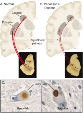 Figure 1. Neuropathology of PD.  
