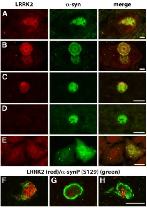 Figure 2. Co-localization of LRRK2 and α-synuclein in PD brain and cell models. In  PD  brains  (A-D,  F-G),  merged  images  clearly  outline  single  neurons  in  the  substantia  nigra (A, B) and  LBs  (B-D, F-G) using double labelling immunofluorescenc