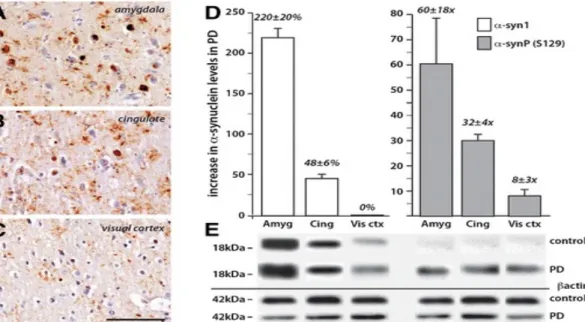 Figure 4. Increased levels of total and S129 phosphorylated α-synuclein in PD brain. 