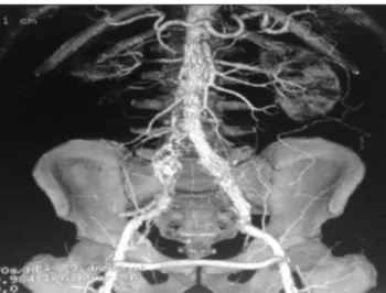 Figura 7. Controle após 12 meses – patência do enxerto. Figura 8. Controle após 12 meses – aneurisma aorto-ilíaco excluído.