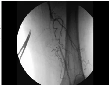 Figura 24.1 - Angioplastia de artéria femoral supericial durante o procedimento.  Observar o balão de dilatação, ainda não insulado, no interior da artéria.