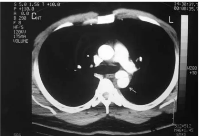 Figura 2 - A) Angiografia revelando pseudoaneurisma em aorta