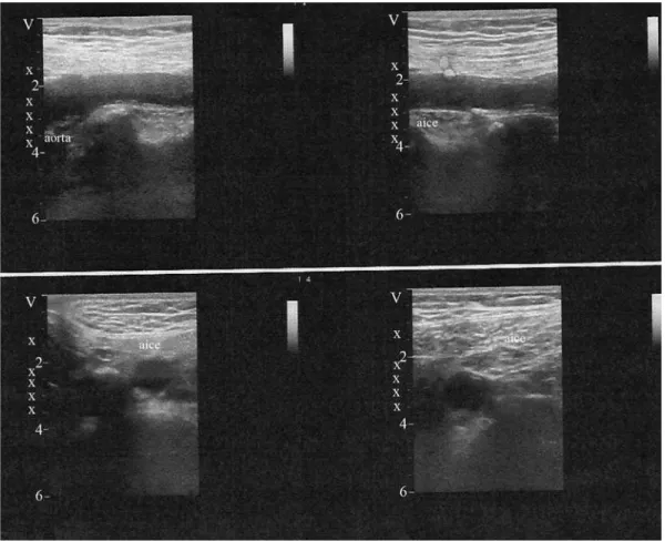 Figura 3 - A) Posicionamento do paciente na mesa operatória em sobre um coxim, em decúbito lateral direito, com o braço esquerdo acima