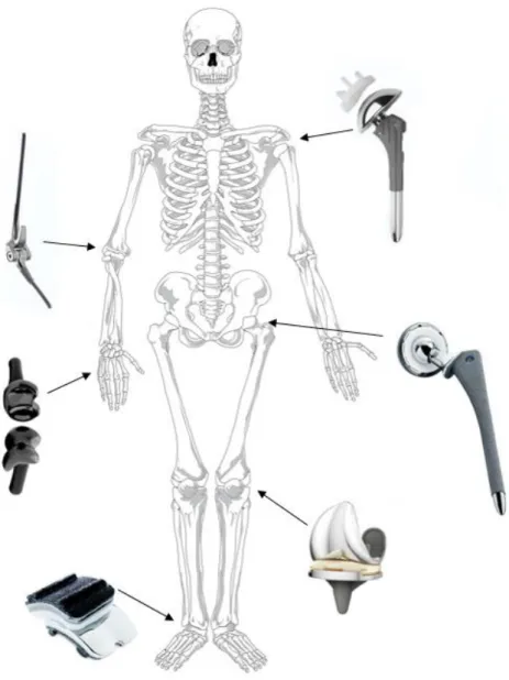 Figura 1 - Aplicação de próteses articulares; adaptado de (Wikipedia 2014b; Zimmer 2014b, 2014a; Integra 2014; 