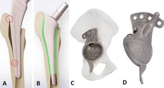 Figura 13 - A: simulação no AQ Fit Program, a prótese standard não encaixa; B: prótese à medida com bom ajuste; C: 
