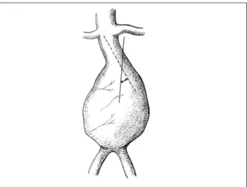 Figura 1 - Medida do ângulo do colo do aneurisma segundo Sternberg et al. 38