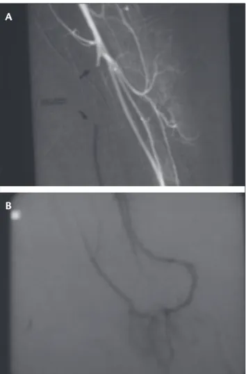 Figura 5 - Fratura do acrômio consolidadaFigura 3 - A) Artéria ulnar ocluída logo após a sua origem; B) 