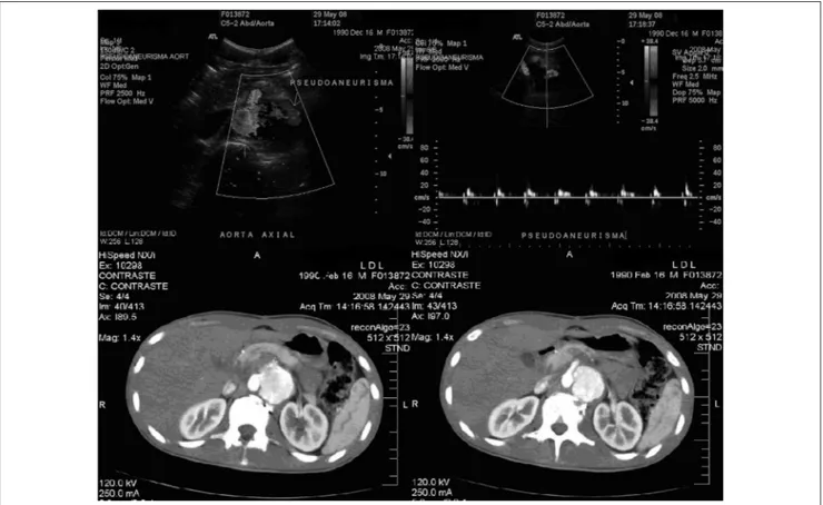 Figura 1 - EcoDoppler de aorta abdominal mostrando luxo no interior do hematoma (acima); tomograia computadorizada de abdome revelando 
