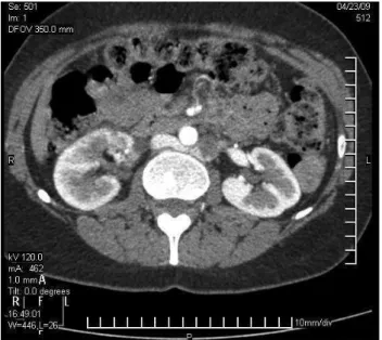 Figura 3 - Corte axial de angiotomograia computadorizada contrastada, 