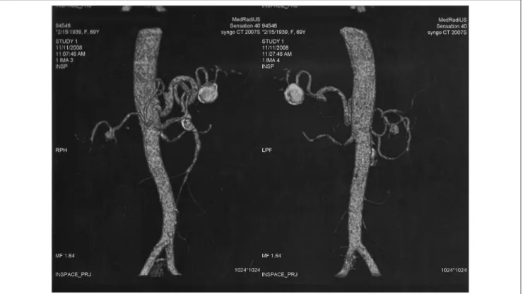 Figura 3 - Angiotomografia de aorta abdominal: dilatação aneurismática em artéria esplênica, artéria mesentérica superior e artéria renal direita