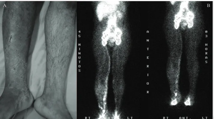 Figura 1 - A) Paciente masculino, 42 anos, úlcera de membro inferior direito há 18 meses, com 2 recorrências; B) linfocin-