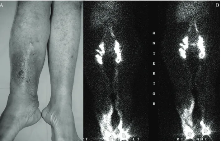 Figura 4 - A) Paciente masculino, 28 anos, úlcera em membro inferior direito com duração de 24 meses e 1 recorrência; B)