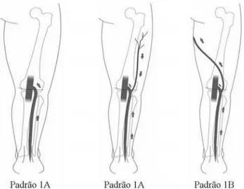 Figura 5 - Terminações da safena parva: padrão 3A) terminação