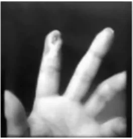 Figura 5 - Lesão residual da necrose de ponta de dedo desenca-
