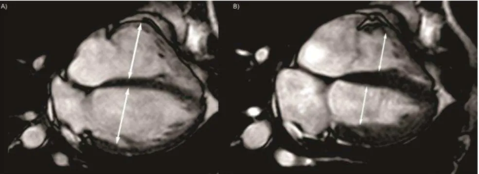 Figura  1  –  Imagens  no  plano  4Ch  do  coração  em  diástole  (A)  e  sístole  (B),  mostrando as medidas dos diâmetros dos ventrículos esquerdo e direito