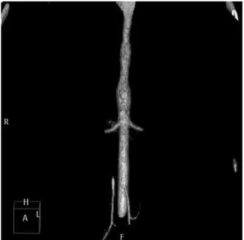 Figura 1 - A) Angiotomografia de aorta toracoabdominal evi-