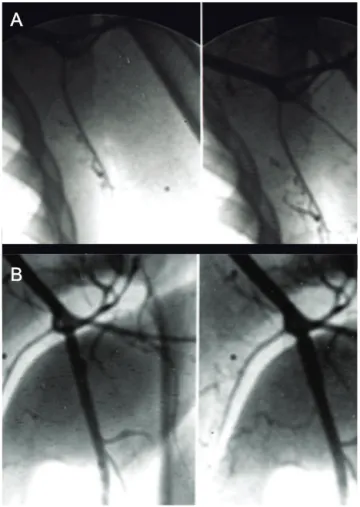 Figura 5 - Angiografia digital do caso 3: A) trombose da artéria braquial esquerda; B) dilatação da