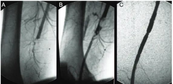 Figura 8 - Angiografia digital do caso 4: A) trombose da artéria femoral superficial direita; B)