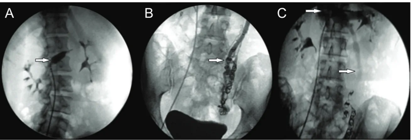 Figura 3 - Tratamento endovascular: A) angioplastia com balão da veia renal esquerda; B) plexo varicoso embo-